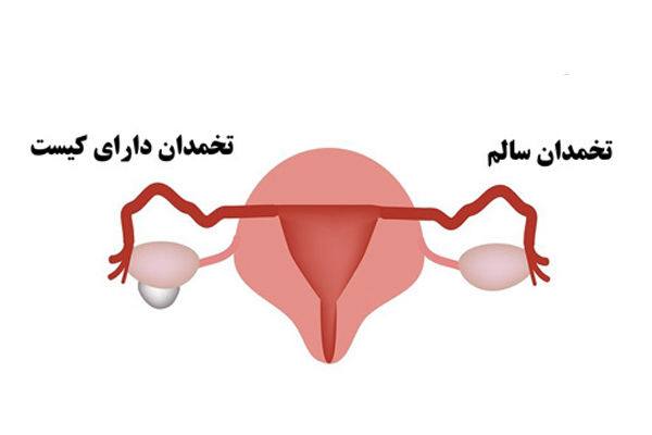 کیست تخمدان